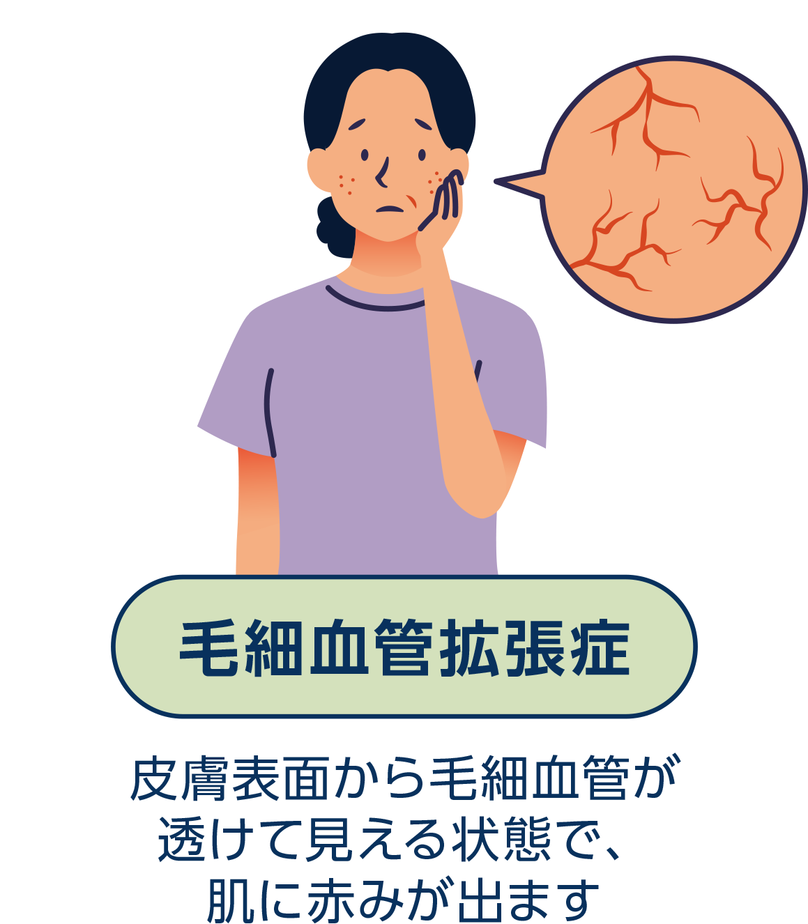 毛細血管拡張症