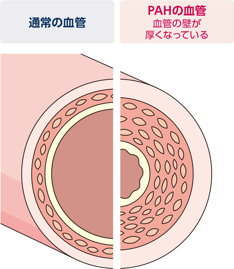 通常の血管とPAHの血管の比較イメージ