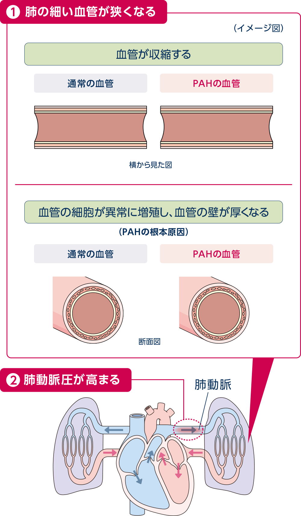 PAHの原因
